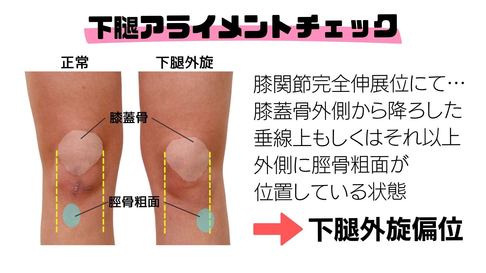 臨床 リハビリの情報発信 Sur Twitter 下腿アライメント 膝痛のある方に多くみられる 下腿外旋偏位 膝関節における静的安定性機構が働きにくくなり疼痛を引き起こす要因となります 下腿内旋を促すために内側ハムストの収縮を促すことも効果的ですが ぜひ可動