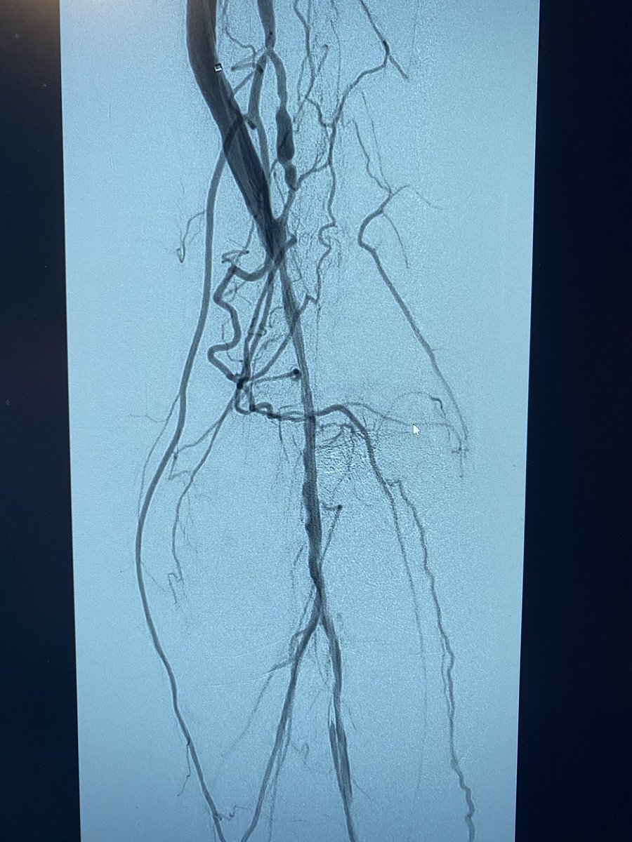 DonGarbettMD's tweet photo. Value of IVUS in PAD. Selecting treatment. Without IVUS I would dilate this to 4mm. With IVUS #Hawkone and 5.5 mm PTA. https://t.co/G4fiBYk2tS
