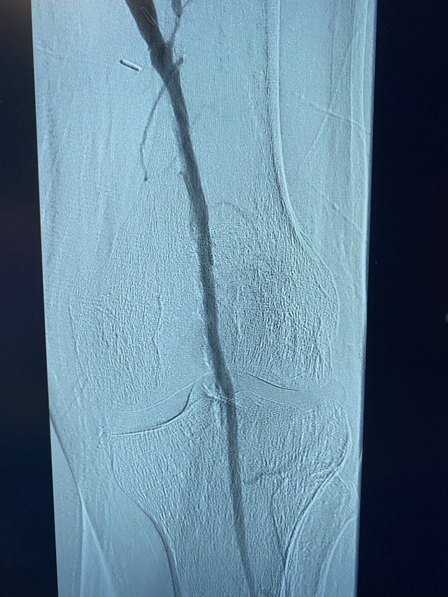 DonGarbettMD's tweet photo. Value of IVUS in PAD. Selecting treatment. Without IVUS I would dilate this to 4mm. With IVUS #Hawkone and 5.5 mm PTA. https://t.co/G4fiBYk2tS