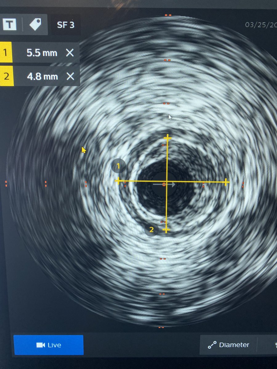 DonGarbettMD's tweet photo. Value of IVUS in PAD. Selecting treatment. Without IVUS I would dilate this to 4mm. With IVUS #Hawkone and 5.5 mm PTA. https://t.co/G4fiBYk2tS