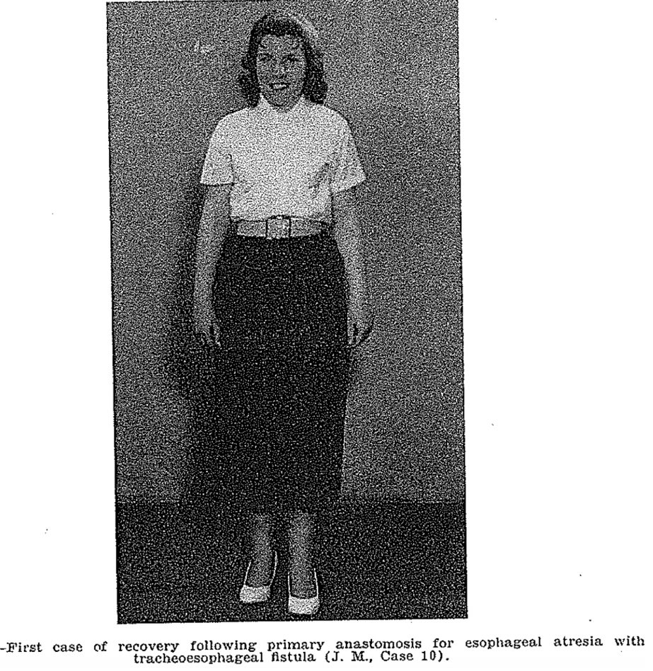 CirugiaPediaMx's tweet photo. Esta es la foto de la primer paciente que sobrevivió a la reparación de una atresia de esófago.
Fue operada por el Dr. Cameron Haight en 1941. Antes de ella había reportado 9 pacientes que habían fallecido. 
1er foto: 11 meses de edad. 2a foto: 16 años de vida.
#SoMe4PedSurg 👶🏻 https://t.co/gdfTas1I5i