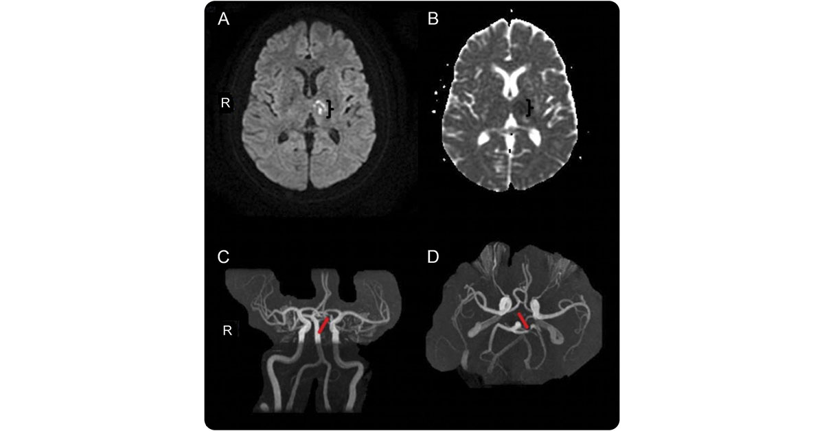 GreenJournal's tweet photo. Acute pathologic crying may be a presentation of stroke. https://t.co/EwKzt3s6Xr #Neurology #NeurologyRF https://t.co/orQB7nvQoN