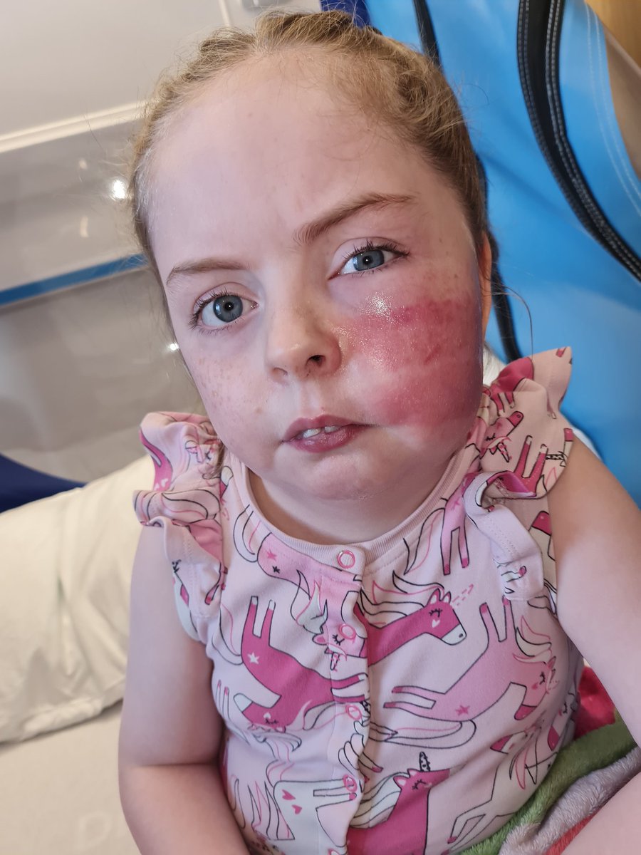 HannahMeIDD8P's tweet photo. When two months in Non convulsive status isn't enough you have an allergic reaction to the tape holding your NG tube too. Tube removed for now and we'll syringe feeds until PEG can be arranged. Ketones good though 🤞
#Epilepsy #EpilepsyKeto #LennoxGastautSyndrome #InvDuDel8p https://t.co/PJHUctl7uu