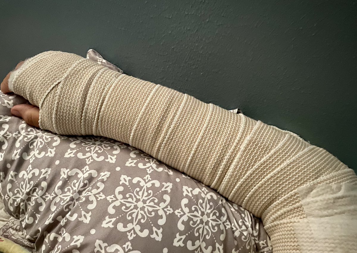 SpragueCL's tweet photo. Took one for the coaching staff last night. 🤷🏼‍♀️ A foul line drive (while calling pitches) made a direct hit to the forearm. 😳 It is broken in 2 places. The ulna almost snapped completely and the impact was so bad it radiated up the bone and fractured my elbow, too. 🤦🏼‍♀️ https://t.co/xbDKG9id3O
