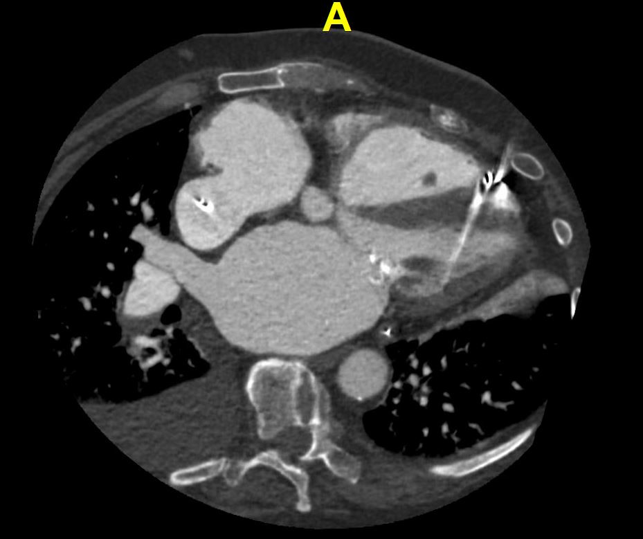 crfshj's tweet photo. Procedural Vignettes in #StructuralHeart Disease
Intravascular #Lithotripsy (#IVL) Assisted Percutaneous Balloon #Mitral #Valvuloplasty (#PBMV): Refining the Technique by Chaddha et al. at https://t.co/KeZjbnkgJ1
#cardiotwitter #cardiology https://t.co/SzNsHTfd9J
