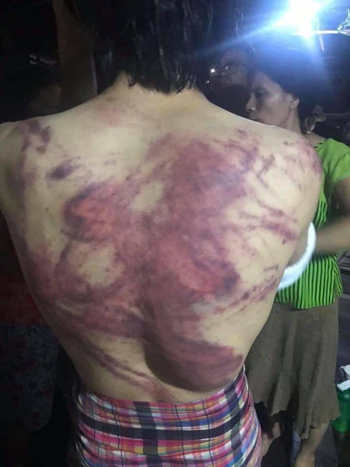 Pencilo4's tweet photo. A student who was abducted on March 16 is now released with all the bruises, contusions, and wounds. 
ANTIFASCIST REVOLUTION
#AntiFascistRevolution2021
#Mar27Coup
#WhatsHappeningInMyanmar https://t.co/8b4u66gE00