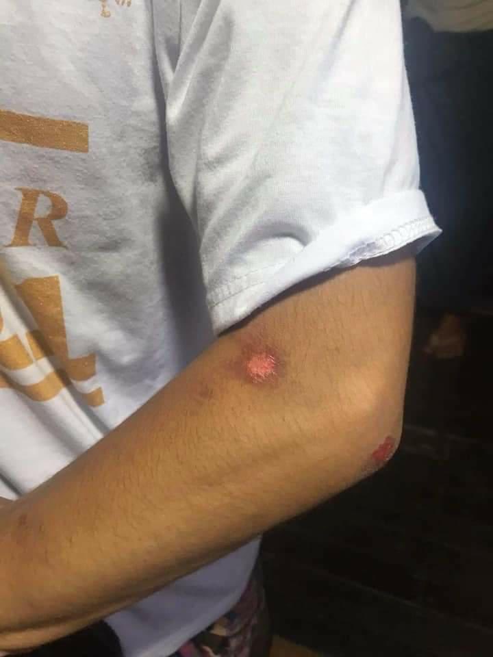 poemamhethar's tweet photo. Tw // wound 
A man who was arbitrarily arrested yesterday has returned home today with several beaten &amp; tortured wounds. 
#WhatsHappeningInMyanmar #Mar27Coup https://t.co/rw9eGmCDi5