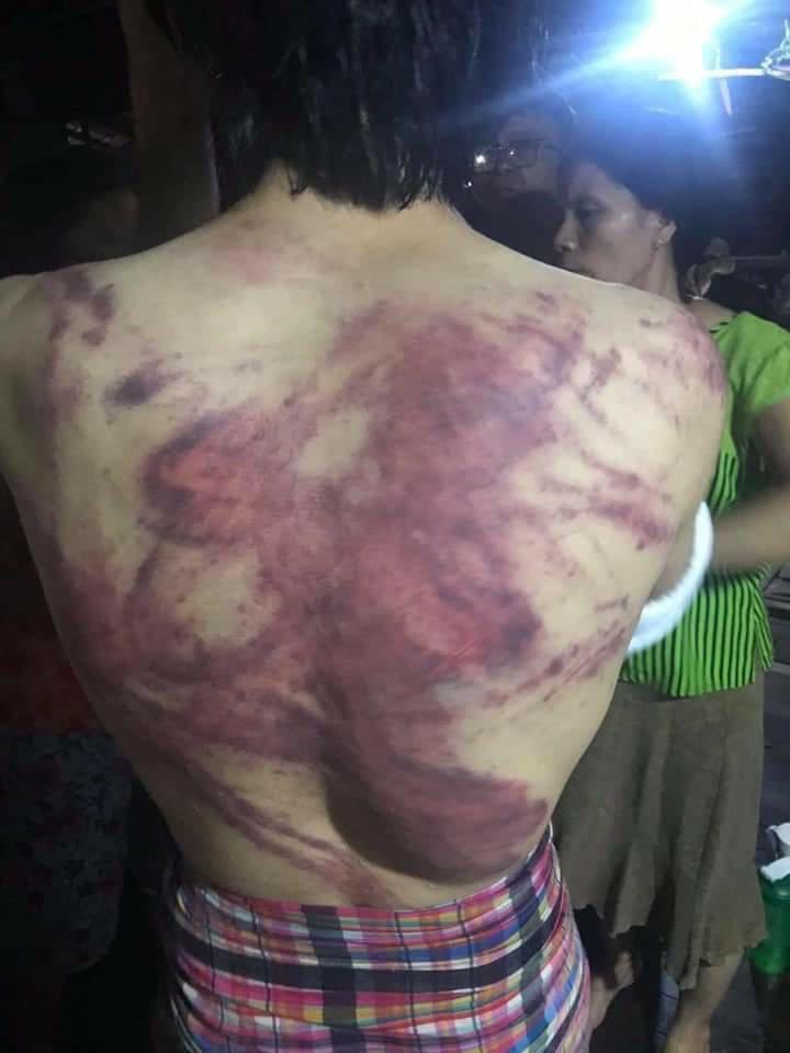 poemamhethar's tweet photo. Tw // wound 
A man who was arbitrarily arrested yesterday has returned home today with several beaten &amp; tortured wounds. 
#WhatsHappeningInMyanmar #Mar27Coup https://t.co/rw9eGmCDi5