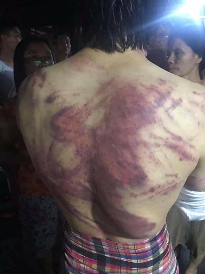 poemamhethar's tweet photo. Tw // wound 
A man who was arbitrarily arrested yesterday has returned home today with several beaten &amp; tortured wounds. 
#WhatsHappeningInMyanmar #Mar27Coup https://t.co/rw9eGmCDi5