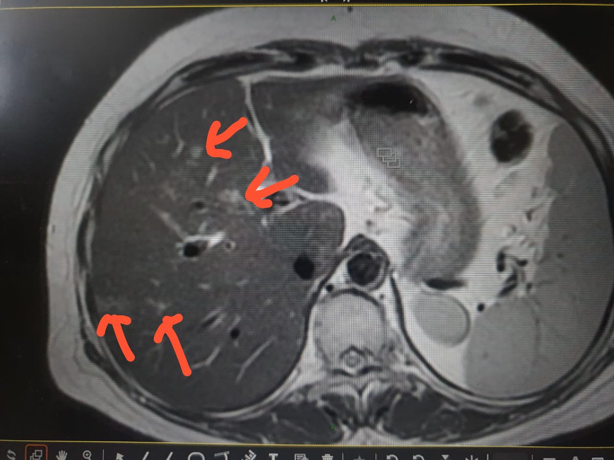 Mansi Khanderia On Twitter Systemic Treatment Folfoxiri Along With Targeted Therapy If Good Response Then Discuss About Local Therapy Options For Liver Mets Virajlavingia Whatsay Https T Co Ebloow8vff
