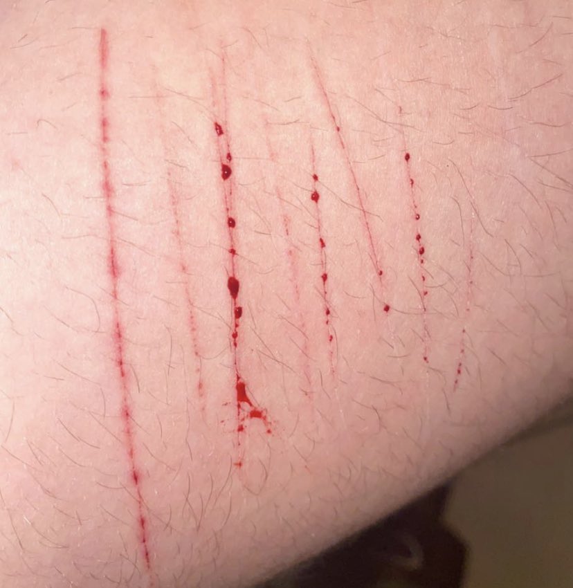 Bl4AD3's tweet photo. hey hey 💕 not too deep yet i’m just out of recovery  
TW: SH/ CUTS!!!
.
.
.
.
.
.
.
.
.
.
.
.
.
.
.
.
.
.
.
(YES MY LEGS ARE HAIRY DONT MAKE FUN OF ME I WENT THROUGH A DEPRESSIVE EPISODE AND RELATIONSHIP ISSUES :(.) https://t.co/77SvbcShgp