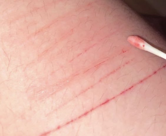 Bl4AD3's tweet photo. hey hey 💕 not too deep yet i’m just out of recovery  
TW: SH/ CUTS!!!
.
.
.
.
.
.
.
.
.
.
.
.
.
.
.
.
.
.
.
(YES MY LEGS ARE HAIRY DONT MAKE FUN OF ME I WENT THROUGH A DEPRESSIVE EPISODE AND RELATIONSHIP ISSUES :(.) https://t.co/77SvbcShgp