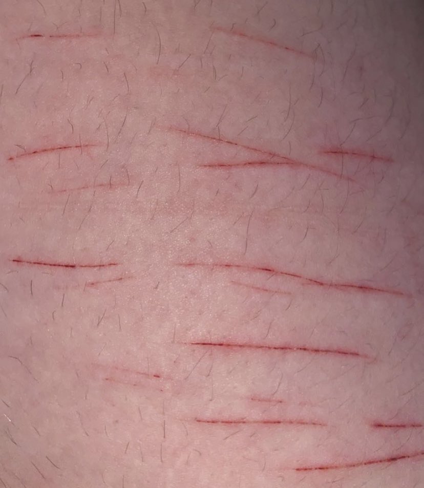 Bl4AD3's tweet photo. hey hey 💕 not too deep yet i’m just out of recovery  
TW: SH/ CUTS!!!
.
.
.
.
.
.
.
.
.
.
.
.
.
.
.
.
.
.
.
(YES MY LEGS ARE HAIRY DONT MAKE FUN OF ME I WENT THROUGH A DEPRESSIVE EPISODE AND RELATIONSHIP ISSUES :(.) https://t.co/77SvbcShgp