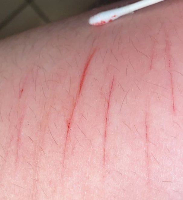 Bl4AD3's tweet photo. hey hey 💕 not too deep yet i’m just out of recovery  
TW: SH/ CUTS!!!
.
.
.
.
.
.
.
.
.
.
.
.
.
.
.
.
.
.
.
(YES MY LEGS ARE HAIRY DONT MAKE FUN OF ME I WENT THROUGH A DEPRESSIVE EPISODE AND RELATIONSHIP ISSUES :(.) https://t.co/77SvbcShgp