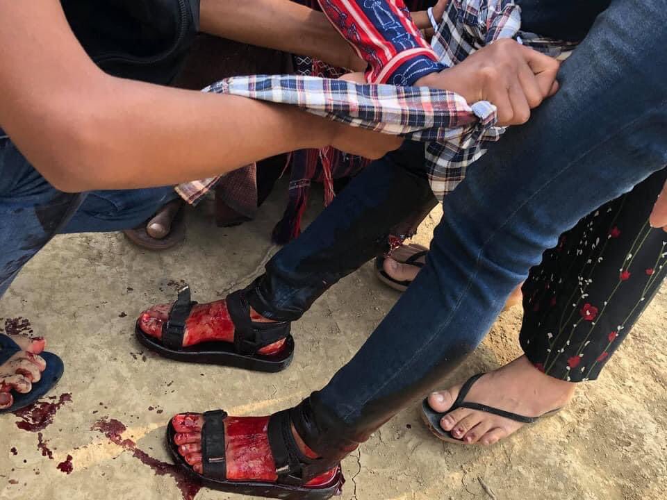 ChawSu00880278's tweet photo. Civilians are shot to head, legs by terrorists at #Phado #Bago. #WhatsHappeningInMyanmar #Mar27Coup @SkyNews @Juarawee @john_hq3 @MaryLawlorhrds https://t.co/jVr4hvbVs3