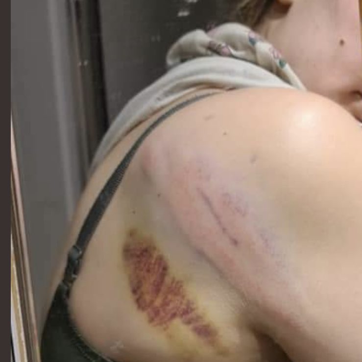 I’ve been given permission to share these pictures from someone assaulted last night in Bristol. 

From the response of the media, police and government this either didn’t happen or is entirely fine.