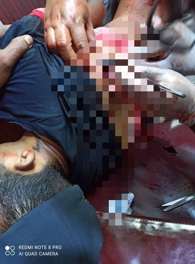 Waiyan699's tweet photo. tw // wound // blood 
In Shwe Bo city, several civilians got shot with live ammunitions by military junta terrorists.
ANTIFASCIST REVOLUTION
#AntiFascistRevolution2021
#Mar27Coup
#WhatsHappeningInMyanmar https://t.co/c2eeEM8V8H