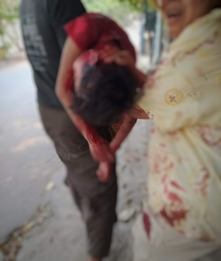 poemamhethar's tweet photo. Tw // blood 
📍 Mandalay
5 years old (only five) child was SHOT TO HEAD while he was in his own house and now in critical condition. 
How devastating... ❗️
@UNICEF @UN_EndViolence @SavetheChildren 
#AntiFascistRevolution2021
#Mar27Coup
#WhatsHappeningInMyanmar https://t.co/q9Q0lO9xCu