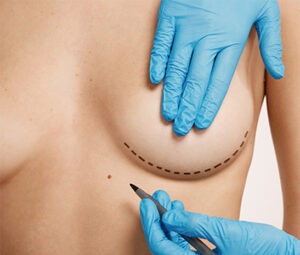 Would love for you to read my article all about BREAST ASYMMETRY SURGERY that I shared today on my LinkedIn account.
linkedin.com/feed/update/ur…
#breastsurgery #breastasymmetry #plasticsurgery #plasticsurgeon #aesthetic