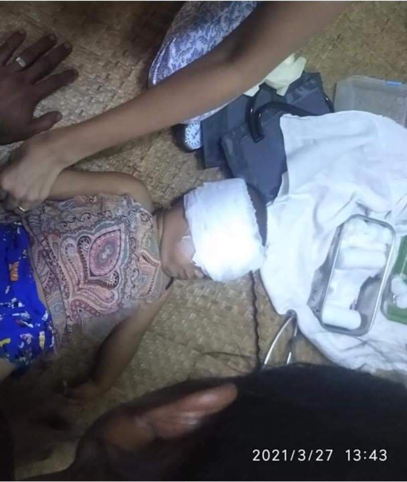 📍 Mayangon Township, Yangon: Even one year old kid is shot by inhuman terrorists and injured at eyes. This is the major crime of brutal #ViolenceAgainstChildren!! 

<a href="/SRSGVAC/">@Moviesda isaimini Ibomma Movierulz 2022</a> 
<a href="/save_children/">Save the Children International</a>
<a href="/UNICEF/">UNICEF</a>

#WhatsHappeningInMyanmar #Mar27Coup