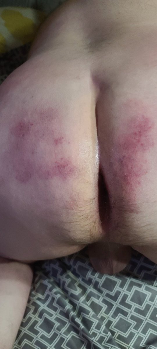 bigboywhore's tweet photo. So this guy just ate my ass for 45 mins and left hickies all over it https://t.co/O4pWMhc2Ep