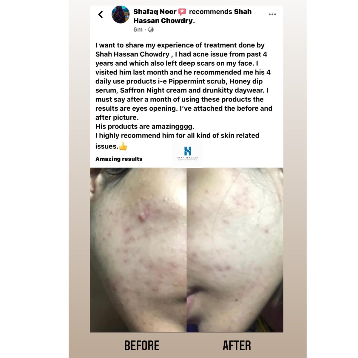 shahhassanch's tweet photo. Latest review, Alhamdulillah.

Thanks for sharing @qafahs 

#shahhassanskincare #acnetreatment #darkcirclestreatment #faircomplexion #skinglow #antiaging #skinfirming #acnescarsremoval #fractionallaser #shahhassanchowdry #google #shahhassanch #acnespottreatment #vampirefacelift https://t.co/M82mvIeKba