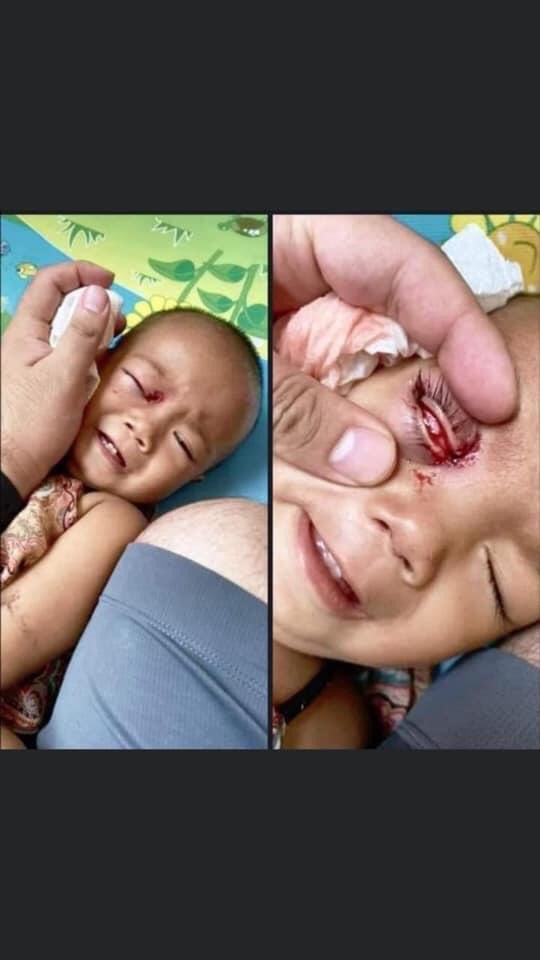 A one-year-old boy was shot in the eye with rubber bullets by Military Terrorists in Thamine MyoThit 1 ward,#Mayangone, Yangon at around 1pm today. His parents said he was shot while playing on the platform of Thamine ZayBuThar.
#Mar27Coup
#WhatsHappeningInMyanmar #SaveChildren