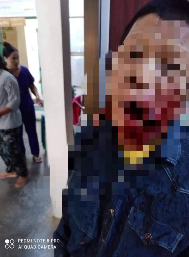 HelenLun5's tweet photo. tw // wound // blood 
In Shwe Bo city, several civilians got shot with live ammunitions by military junta terrorists.
ANTIFASCIST REVOLUTION
#AntiFascistRevolution2021
#Mar27Coup
#WhatsHappeningInMyanmar https://t.co/7269yDG2t4