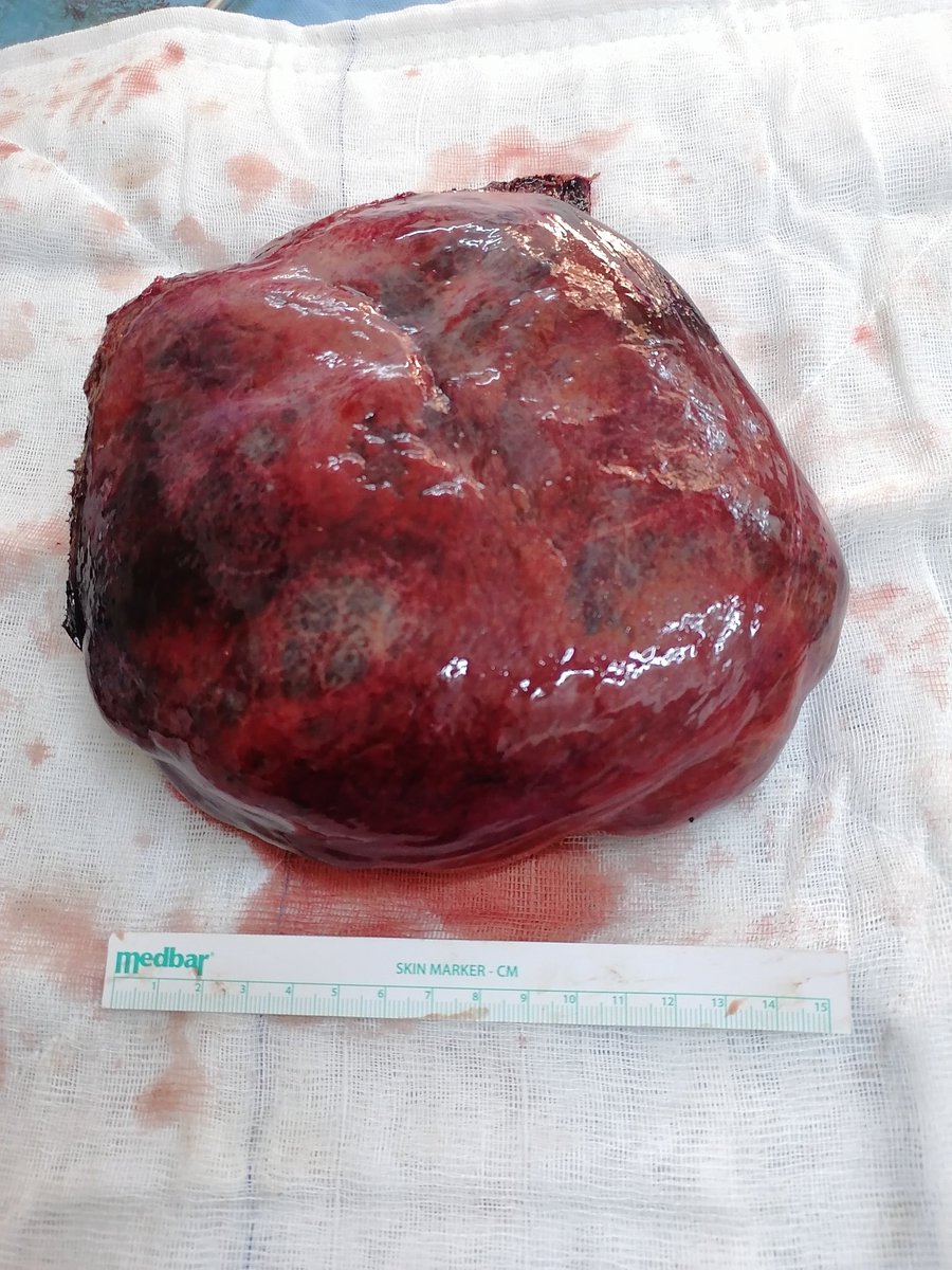 31 yaş kadın hasta. Karaciğer sol lobda yerleşen yaklaşık 20 cm dev hemanjiom(damar yumağı) 1 buçuk saat süren operasyonla çıkarıldı. (karaciğer sol lateral segmentektomi). Kendisine sağlıklı günler dilerim
#cerrahionkoloji #kansercerrahisi #şanlıurfa #hepatobiliercerrahi