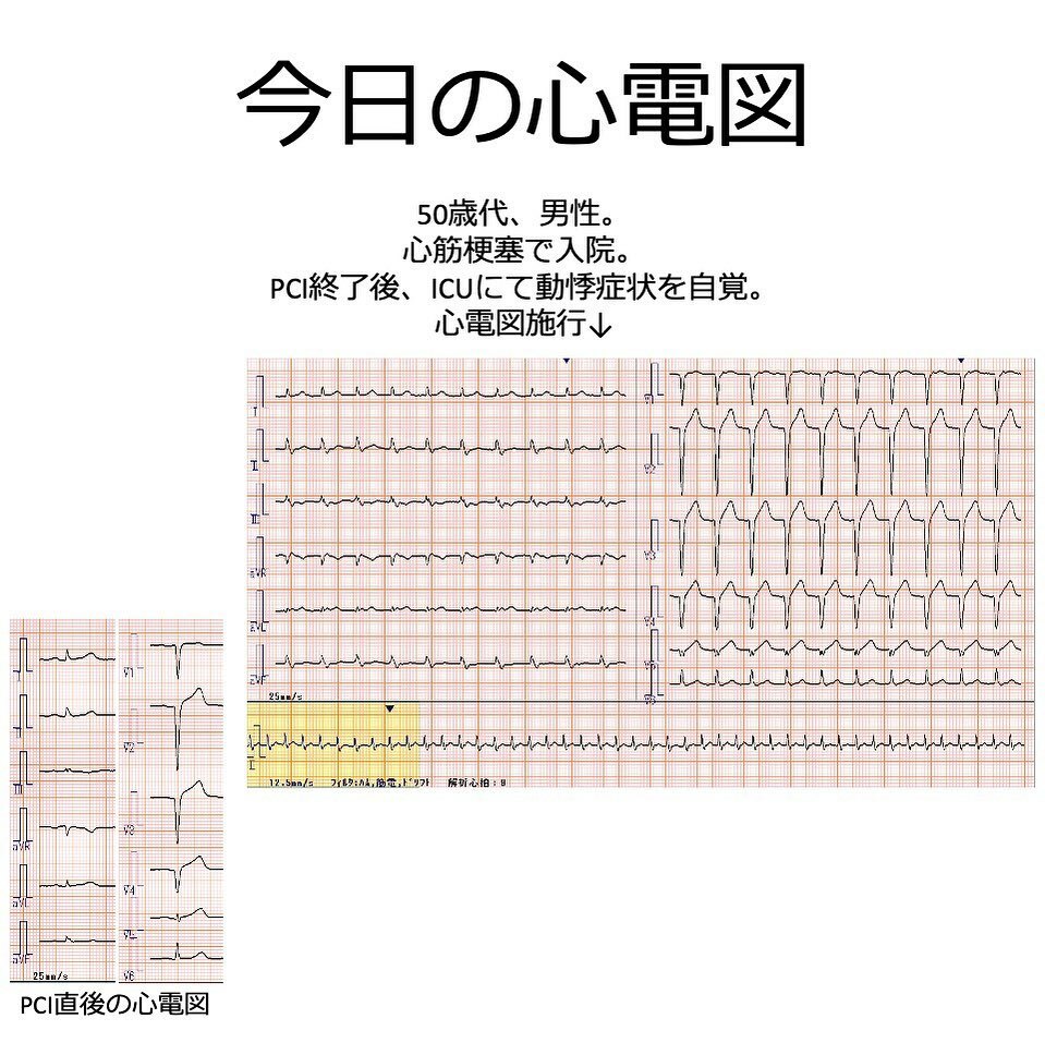 雑草循環器内科医 南の島 On Twitter 前回と同じ症例です ドキドキ なんだろう 心電図 心電図の勉強 心電図検定 循環器 研修医 看護師 生理検査技師 臨床工学技士