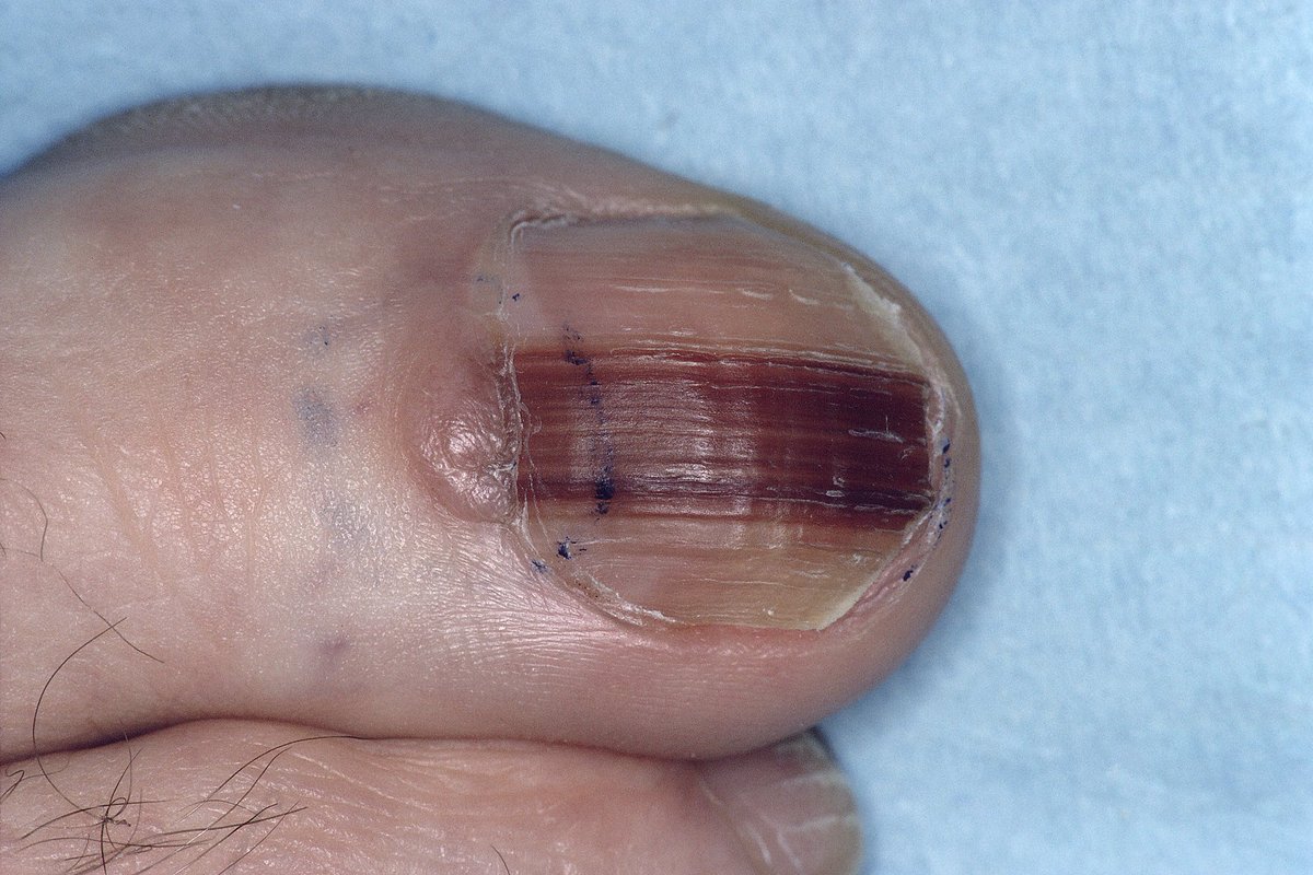 OurFavOnlineDoc's tweet photo. IF your nail looks like this,
IF a line just appeared on your nail,
IF the line gets wider and irregular,

PLS SEE A DOCTOR ASAP.
You may have what we call Subungual Melanoma.

Pls NEVER ignore it. This is Nail Cancer.
It can spread and kill you within 5years.

RT for others pls. https://t.co/SvSPusdDca