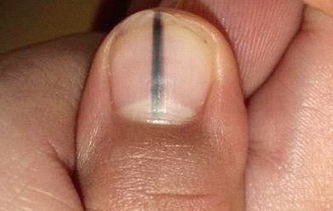 OurFavOnlineDoc's tweet photo. IF your nail looks like this,
IF a line just appeared on your nail,
IF the line gets wider and irregular,

PLS SEE A DOCTOR ASAP.
You may have what we call Subungual Melanoma.

Pls NEVER ignore it. This is Nail Cancer.
It can spread and kill you within 5years.

RT for others pls. https://t.co/SvSPusdDca