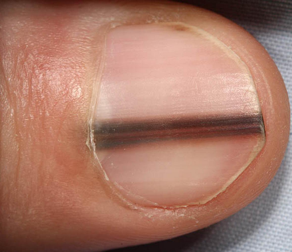 OurFavOnlineDoc's tweet photo. IF your nail looks like this,
IF a line just appeared on your nail,
IF the line gets wider and irregular,

PLS SEE A DOCTOR ASAP.
You may have what we call Subungual Melanoma.

Pls NEVER ignore it. This is Nail Cancer.
It can spread and kill you within 5years.

RT for others pls. https://t.co/SvSPusdDca