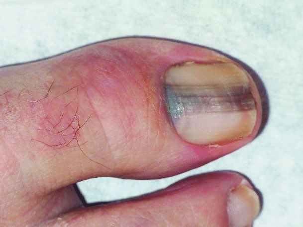 OurFavOnlineDoc's tweet photo. IF your nail looks like this,
IF a line just appeared on your nail,
IF the line gets wider and irregular,

PLS SEE A DOCTOR ASAP.
You may have what we call Subungual Melanoma.

Pls NEVER ignore it. This is Nail Cancer.
It can spread and kill you within 5years.

RT for others pls. https://t.co/SvSPusdDca