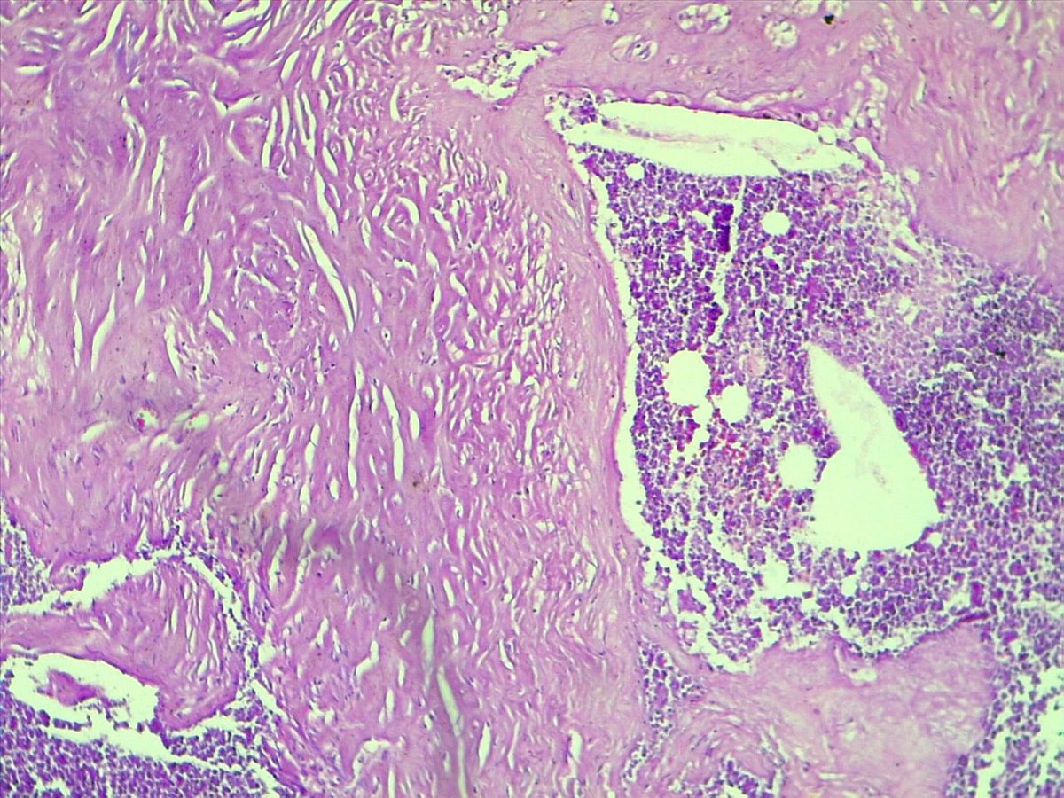 Heeda41491444's tweet photo. 45y mesentric mass with omental mass ur opinion #GITpath #pathologist #pathology 1/2from mesenteric https://t.co/NWOQg6mHfF