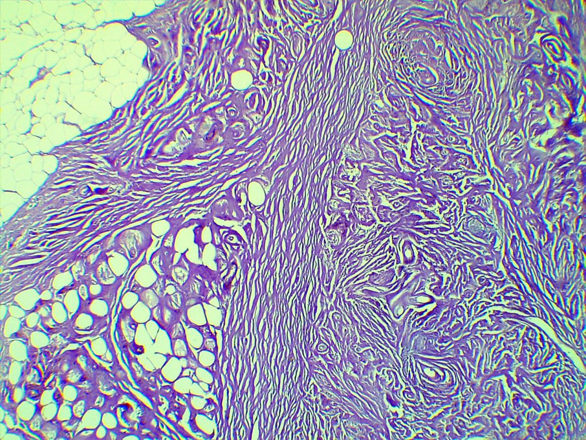 Heeda41491444's tweet photo. 45y mesentric mass with omental mass ur opinion #GITpath #pathologist #pathology 1/2from mesenteric https://t.co/NWOQg6mHfF