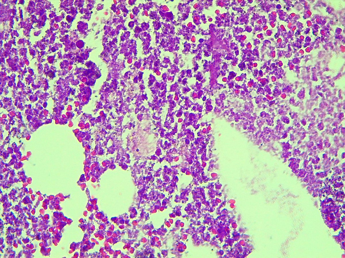 Heeda41491444's tweet photo. 45y mesentric mass with omental mass ur opinion #GITpath #pathologist #pathology 1/2from mesenteric https://t.co/NWOQg6mHfF