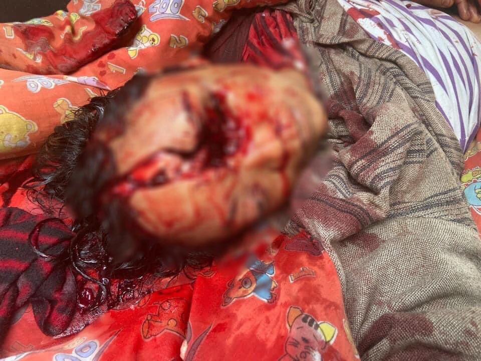 hannayuri_twt's tweet photo. tw // graphic content // blood
Military terrorists continually firing at #Mogok west &amp; total 7 person were injured from live ammunitions this evening.
1 female was shot DEAD in head
2 were shot in the chest and now in critical conditions.
#Mar27Coup
#WhatsHappeningInMyanmar https://t.co/guivVsYa0g