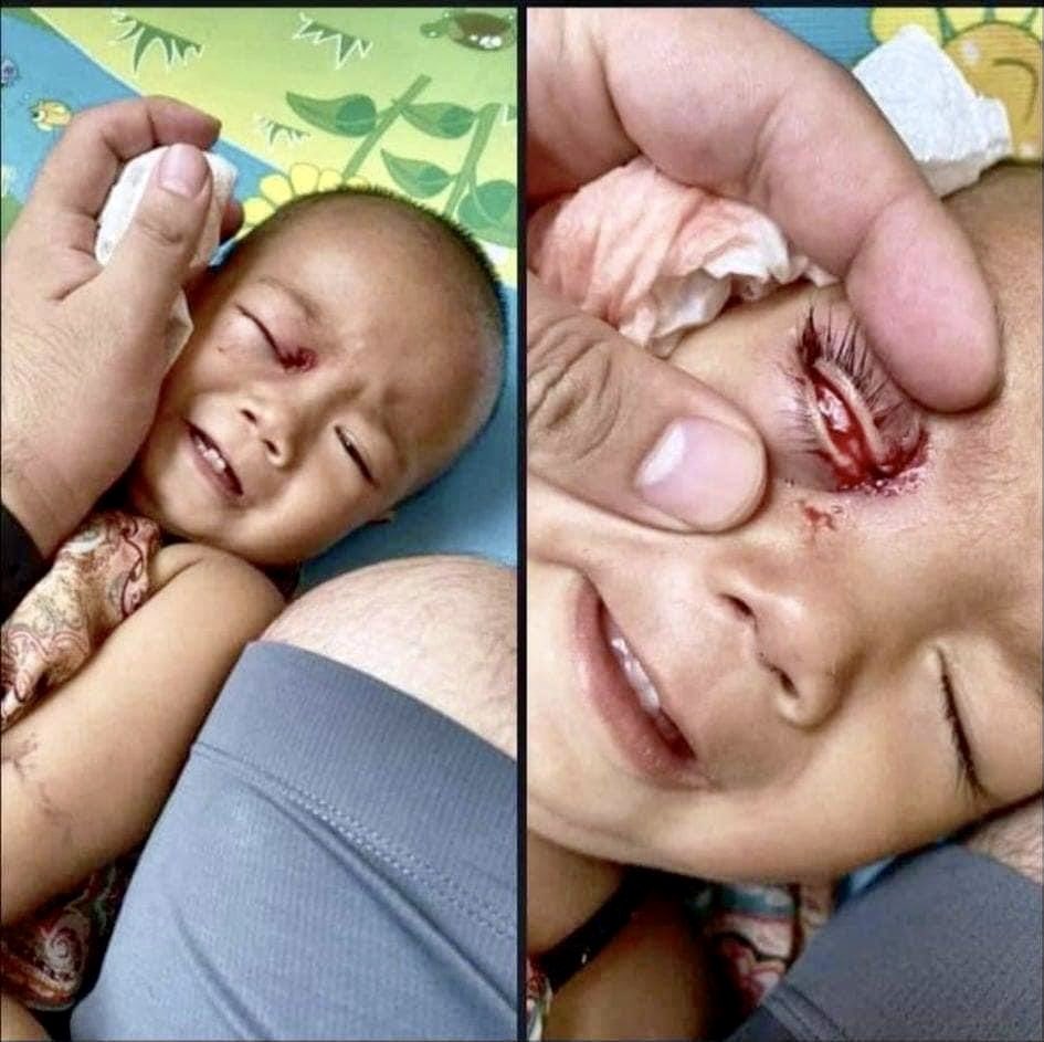 A one year old kid in Mayangone township was shot in the eye with rubber bullet while he was just outside his home playing. #Mar27Coup #SaveChildren #CrimesAgainstHumanity #WhatsHappeninglnMyanmar #SAVETHECHILDERN