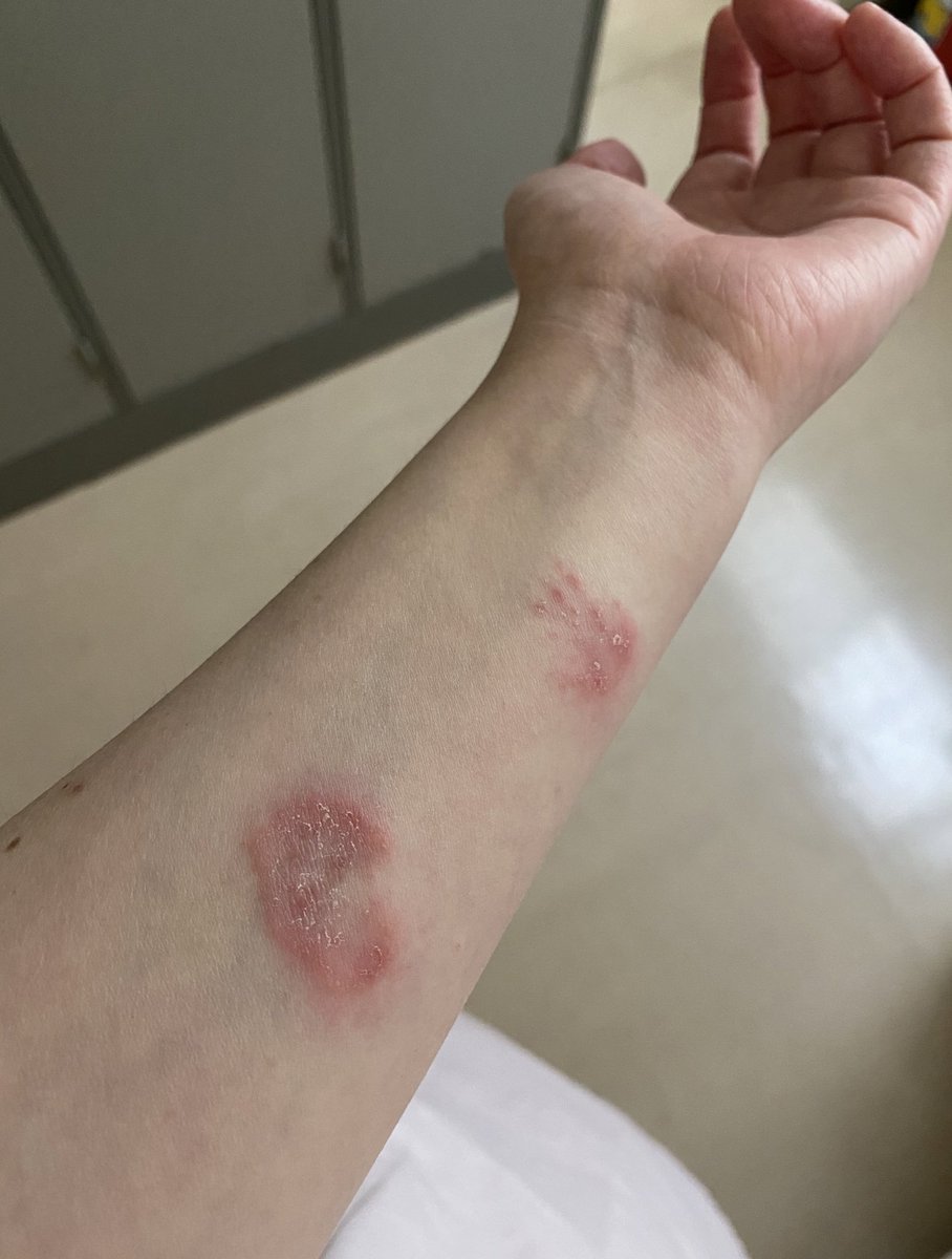 かなりん ハリネズミ グロだよ 腕のあれ カビ出ました カールおじさんの顎からは菌出なかったけど 出現が同時だったのでこちらもその疑惑あり はっきりわからず 一週間での炎症の変化です 犬猫さんからも からももらっちゃうから参考