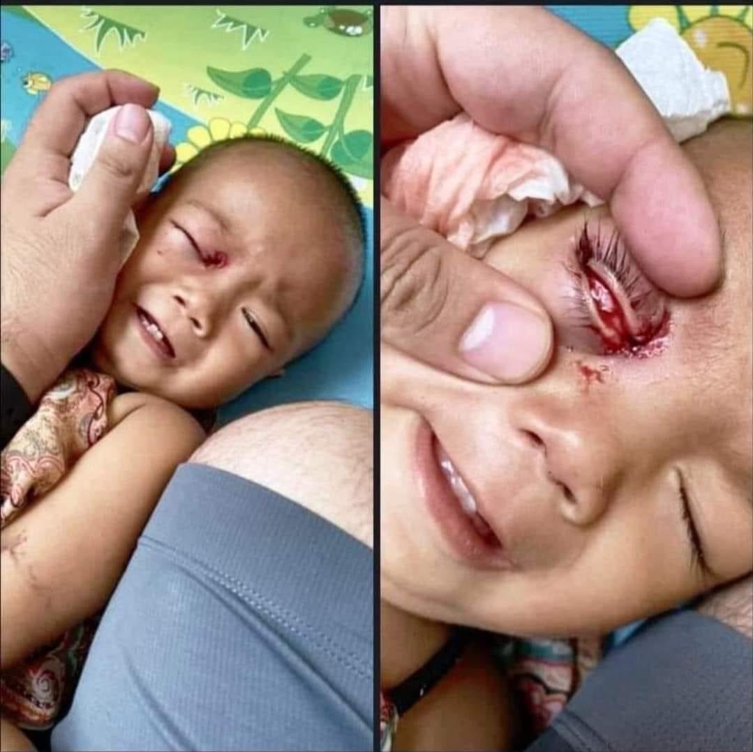 KukuuTaellia's tweet photo. tw // wounds, blood
Thamine, Yangon - Terrorists group shot with rubber bullets to the child's eye and the junta's cruelty continues. #WhatsHappeningInMyanmar #Mar27Coup #PoliceBrutality #CrimesAgainstChildren https://t.co/ZvOTQnWlLD