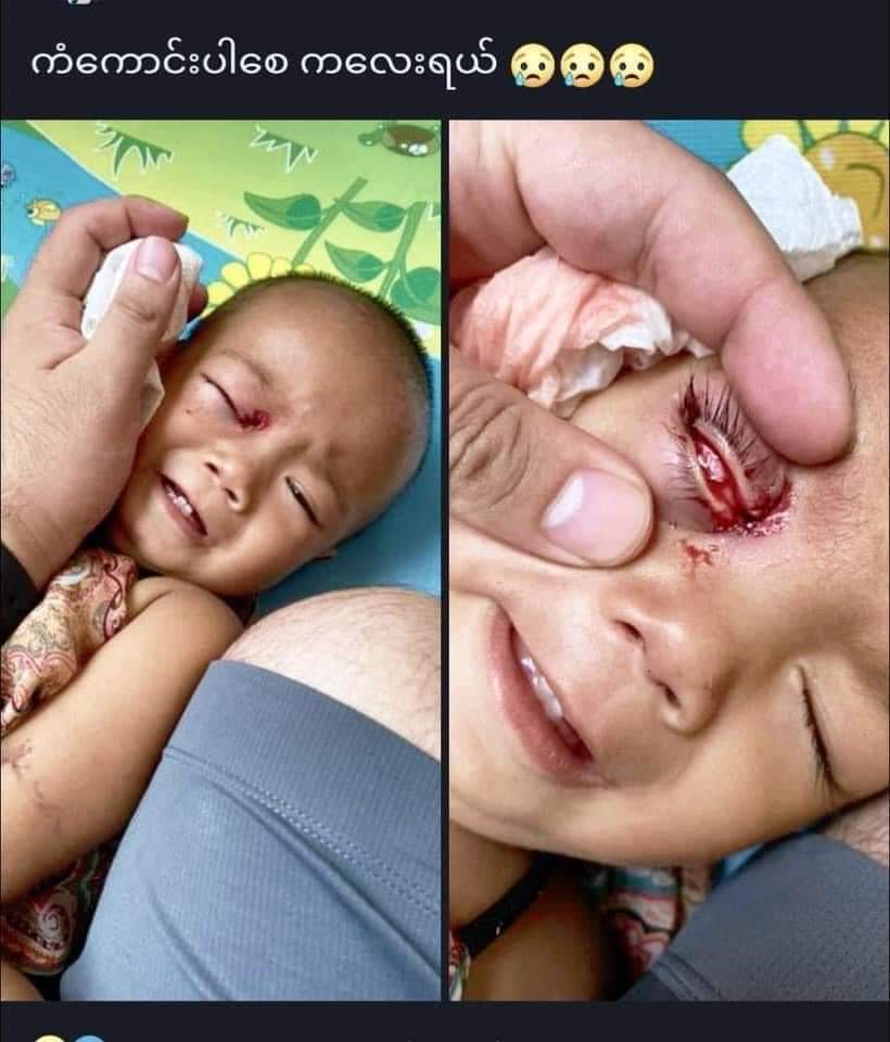 DanielS75737205's tweet photo. @TostevinM 27.Mar.2021 
Speechless inhumanity of Junta Terrorists, just over one-year-old child was shot at eye by rubber bullet in Mayangone, Yangon. 
Please ACT NOW R2P in Myanmar. ANTIFASCIST REVOLUTION
 #WhatsHappeningInMyanmar
 #Mar27Coup
#R2PNowForMyanmar #CrimeAgainstHumanit https://t.co/eYTqPKSbDa