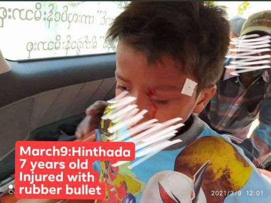 Sthant_XX's tweet photo. Tw // wound 
In HinThaDa, a 7 years old boy got shot with rubber bullets and injured.
ANTIFASCIST REVOLUTION

#CrimesAgainstChildren
#WhatsHappeningInMyanmar https://t.co/BjVmRjT9U2