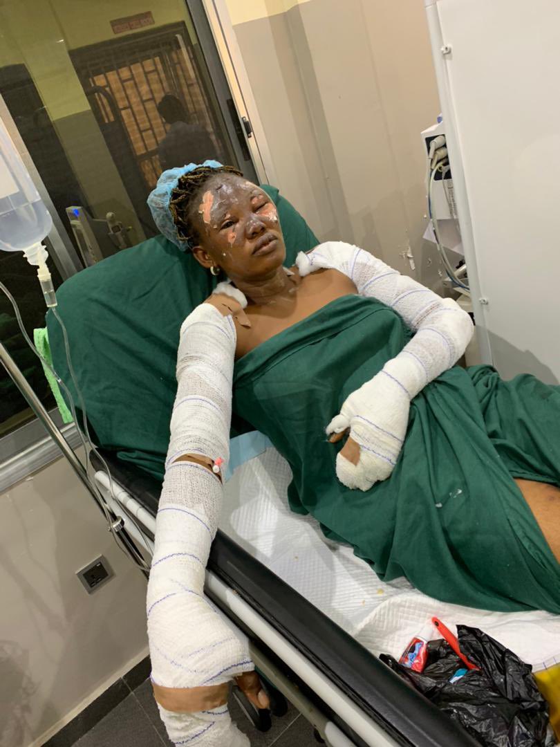 AyomideRachy's tweet photo. MY BATTLE FOR A SECOND LIFE.

On a Monday morning of 10th August 2020, I was on my way to Ibadan from Lagos for my NYSC documentation when a tanker hit our bus and exploded. The bus went up in flames. I could feel the fire burn through my clothes to my skin. https://t.co/iJU6Zd4Er9