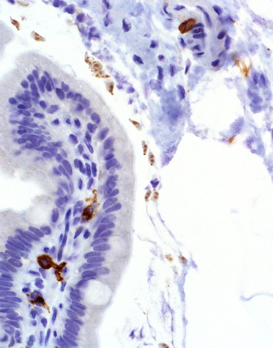 IHC_guy's tweet photo. @Chucktowndoc @JLHornick How often do I order a KIT in giardiasis??? . . . only EVERY time!!!

#EverydayAndTwiceOnSunday
#DontFireUntilYouSeeTheBrownsOfTheirEyes

My favorite ref: C-kit (CD117) immunostain is useful for the diagnosis of Giardia lamblia in duodenal biopsies https://t.co/ibloZRbStR https://t.co/KTwyS3QJ47