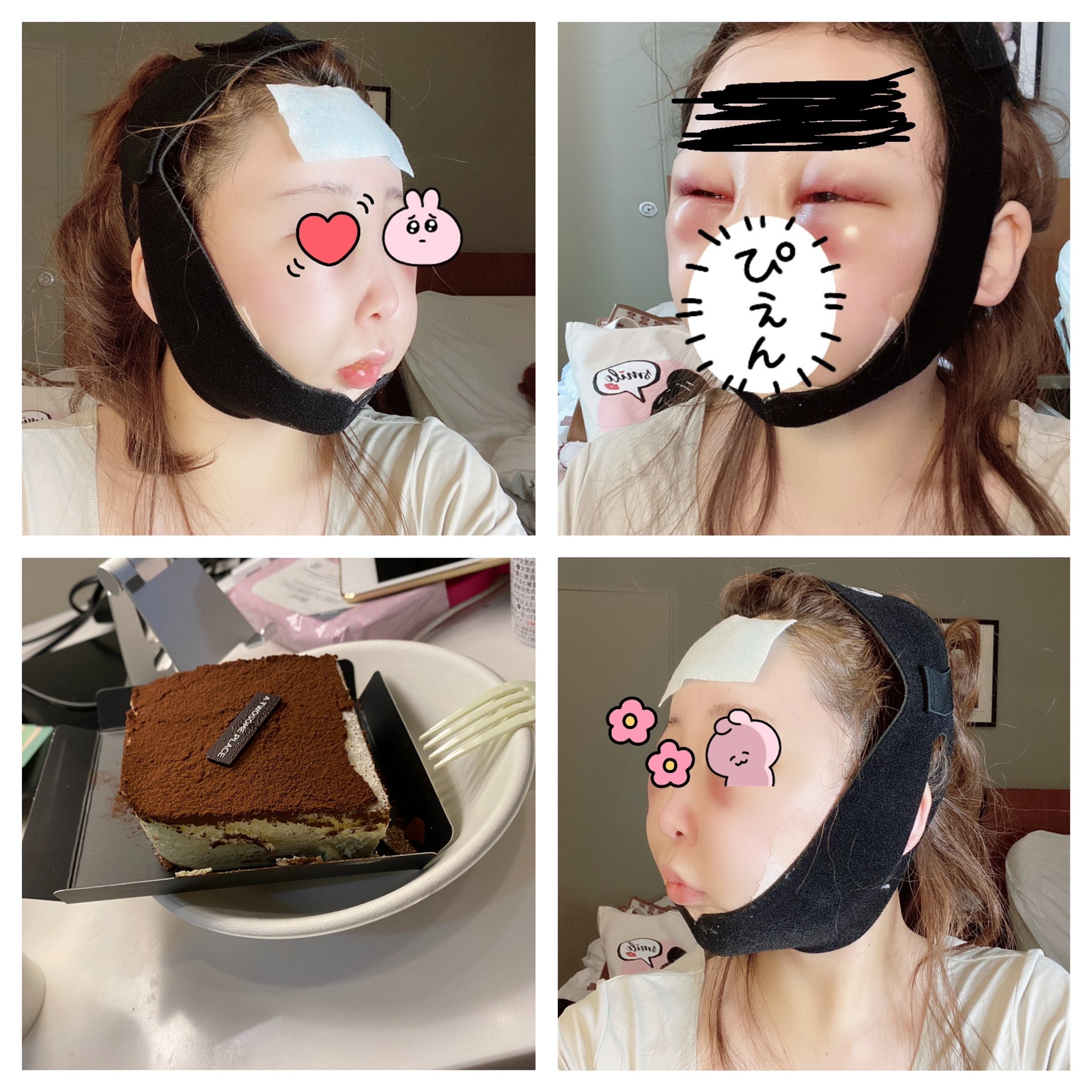 Uzivatel まるまるまるこちゃん Na Twitteru Da 輪郭3点レビュー Dt3日目 顔の痛み 喉の痛み 口の痛み 唇 腫れ 痣 口の開き 指一本くらい 飲食 唇が痛いのでおかゆが辛い ゼリーばかり食べた T Co 44ly3f9uhr