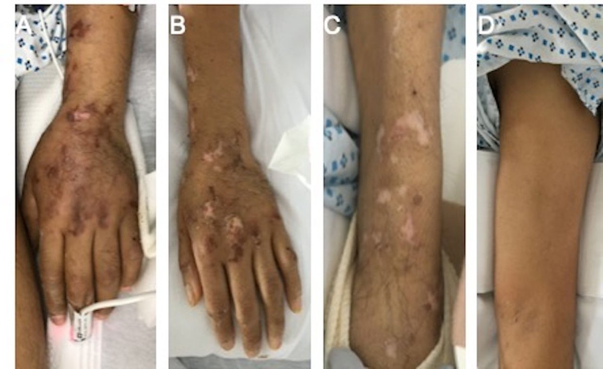 WCMCNeurology's tweet photo. Brachial #plexopathy as a complication of #COVID19
@BMJCaseReports - patient perspective included
Catherine Young Han, Andrew Tarr, @AlexGewirtz, Ulrike Kaunzner, Paula Roy-Burman, Todd Cutler, Daniel MacGowan @WCM_MedChiefs @WCMGIM
https://t.co/fsVWqXkqGQ https://t.co/JUOJAr00Yq