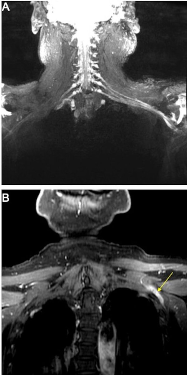 WCMCNeurology's tweet photo. Brachial #plexopathy as a complication of #COVID19
@BMJCaseReports - patient perspective included
Catherine Young Han, Andrew Tarr, @AlexGewirtz, Ulrike Kaunzner, Paula Roy-Burman, Todd Cutler, Daniel MacGowan @WCM_MedChiefs @WCMGIM
https://t.co/fsVWqXkqGQ https://t.co/JUOJAr00Yq
