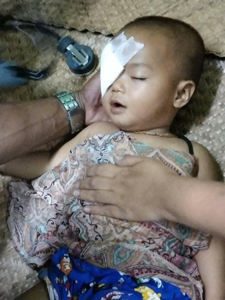 ShunnleiK's tweet photo. Rubber bullet hits one-year-old boy in the eye.A one-year-old boy was shot in the eye by a group of gunmen in the Thamine Myo Thit 1 ward of Rangoon's Mayangone Township at around 1pm today March27.His parents said he was shot while running on the platform of the historic market https://t.co/bQ32raVprU