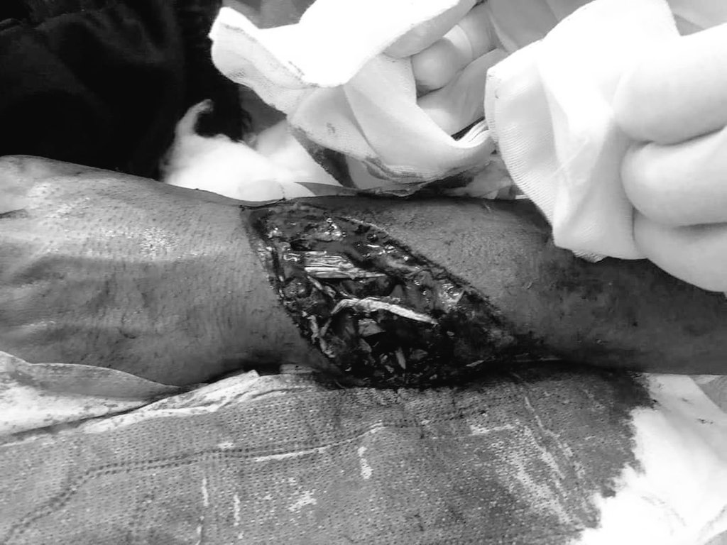 SaveMM99's tweet photo. Tw//blood
According to Shan News Agency,5 Civillians have been shot and injured in #Taunggyi tonight as Military's sponsored Terrorists are continuously shooting tonight.
ANTIFASCIST REVOLUTION
#AntiFascistRevolution2021
#Mar27Coup
#WhatsHappeningInMyanmarsave https://t.co/Zm4HdvfN9E
